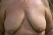 Normal Breasts