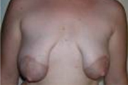 Normal Breasts