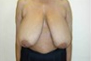 Normal Breasts