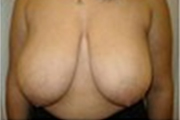 Normal Breasts