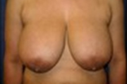 Normal Breasts