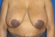 Normal Breasts