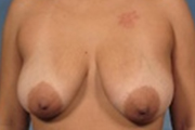 Normal Breasts