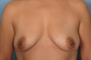 Normal Breasts