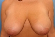 Normal Breasts