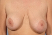 Normal Breasts