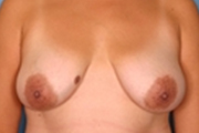 Normal Breasts