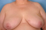 Normal Breasts