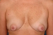 Normal Breasts