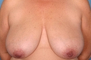 Normal Breasts