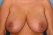 Normal Breasts