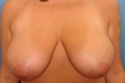 Normal Breasts