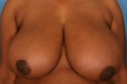 Normal Breasts