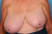 Normal Breasts