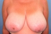 Normal Breasts