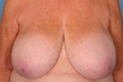 Normal Breasts