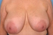 Normal Breasts