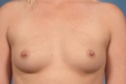 Normal Breasts