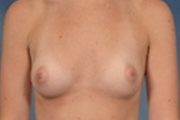 Normal Breasts