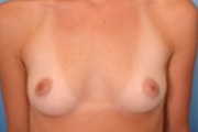 Normal Breasts