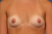 Normal Breasts