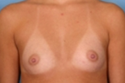 Normal Breasts