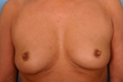 Normal Breasts