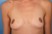 Normal Breasts