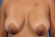 Normal Breasts