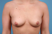 Normal Breasts