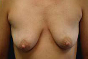 Normal Breasts