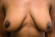 Normal Breasts