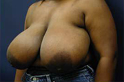 Normal Breasts