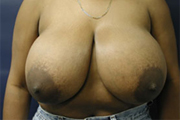 Normal Breasts