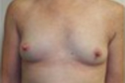 Normal Breasts