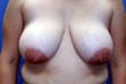 Normal Breasts