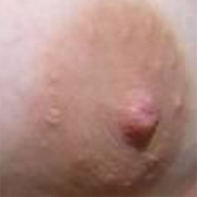 Normal Nipples