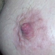 Normal Nipples