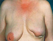 Lower Breast