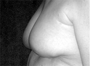 Lower Breast