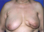 Inner Breast