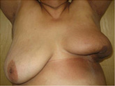 Lower Breast