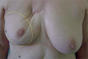 Inner Breast