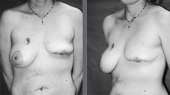 Lower Breast