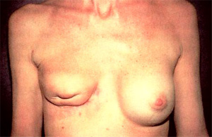 Lower Breast