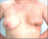 Lower Breast