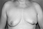 Lower Breast