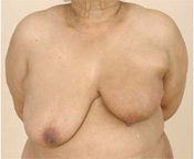 Lower Breast