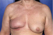 Lower Breast