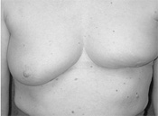 Lower Breast